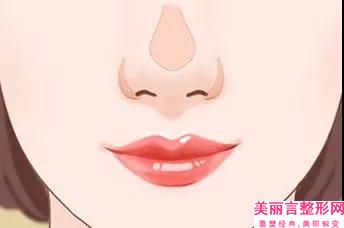 长春解放军第208医院在线咨询-鼻基底用玻尿酸填充价格(价目)表超人气项目安排