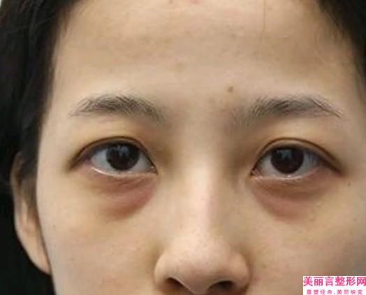 长春市中心医院整形美容科正规吗-吸脂肪祛眼袋价格表(费用)分享