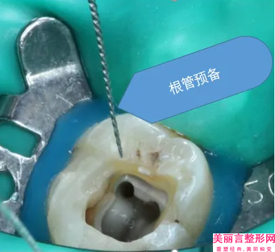 宜宾市树脂牙多少钱-2025年宜宾市树脂牙价格(价目)特惠活动展示