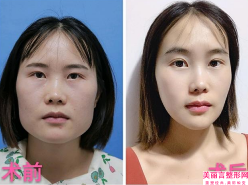 东莞市圆脸打溶脂瘦脸医生强的有哪个(张旭医生对比技术、实力看)