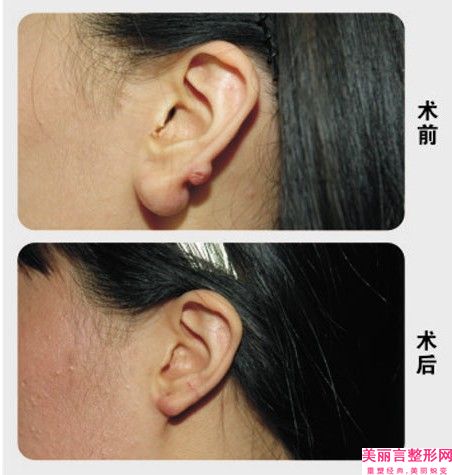 宁德市小孩耳部畸形价目表抢鲜详细-宁德市小孩耳部畸形价格大致需要好多