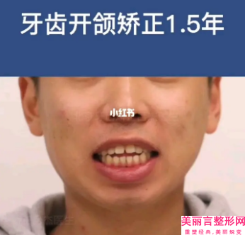 邯郸市专业骨性龅牙矫正医生哪位做的好(江淑敏‌医生比较靠谱)