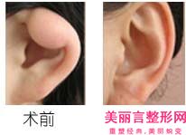 全岳阳市好的耳朵整容得医院(岳阳市耳朵整容得医院排名技术实力强)