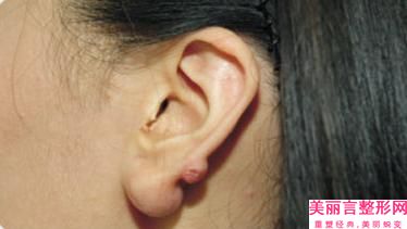 厦门解放军174医院整形美容科价格表(费用)详细全新曝出-先天耳朵畸形手术恢复案例