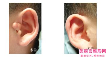 淄博市第一医院整形科价格(价目)正规2025曝光-小耳畸形手术案例