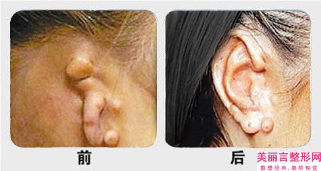 哈尔滨市第二医院整形美容科价格(收费标准)很详细的资料-耳再造直埋法案例