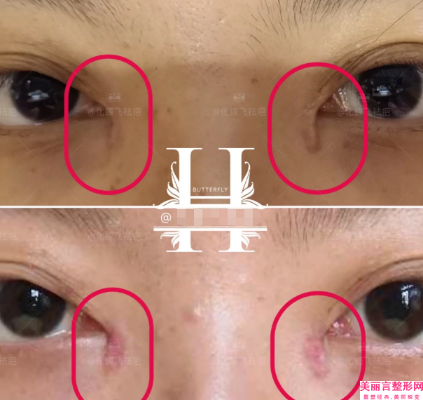 济南艺星美容整形医院法令纹眼纹去除怎么样门诊部实力解读