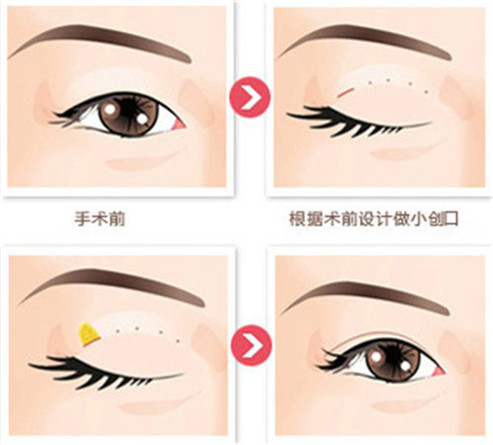 高分子埋线双眼皮效果怎么样呢？ 更加显得增加脸部气质