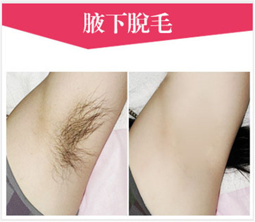 深圳美莱激光脱毛团购价