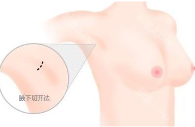 隆胸修复最佳时期是什么时候- 整形美容网 