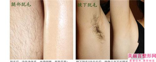 激光去毛术究竟要用多少费用呢