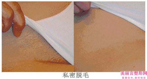 激光去毛手术的费用贵不贵