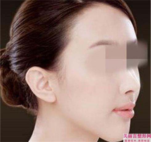 倘若实行副耳消除术会存在甚麽副作用吗