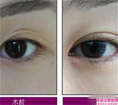华南塑造重睑安全么
