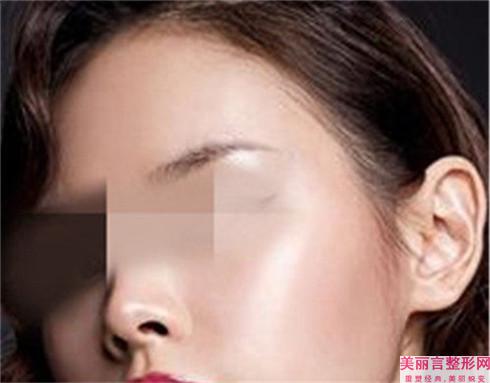 实行副耳去除术过后会具有哪一些后遗症吗