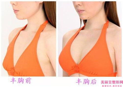 患了乳癌开展单侧乳房再造要花费多少费用