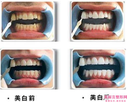 不一样牙齿材料的种植体的普遍价格差距远吗