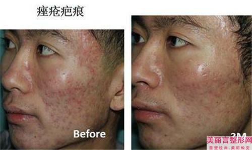 微晶磨皮除痘痘和激光磨皮去痘痘都有什么不同点？哪个好