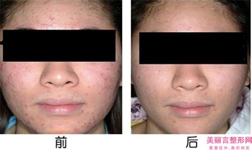 点阵祛痘印长处是哪？有些什么案例展示？