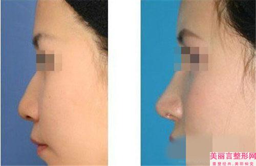 冷敷能不能缓减鼻缺损修复再造后的刺痛感