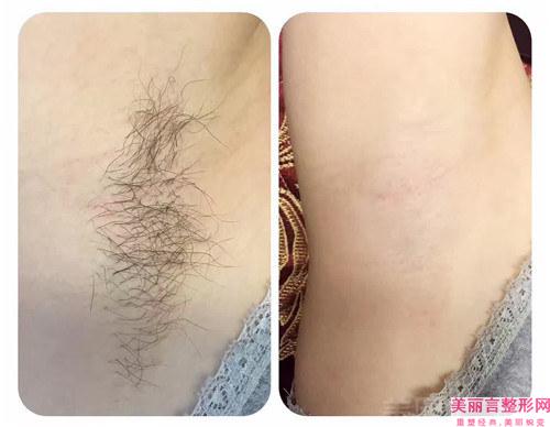 激光能搞定毛手毛脚吗？费用高不高？